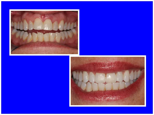 Before & After Invisalign