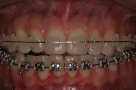 Neuromuscular Braces Treament