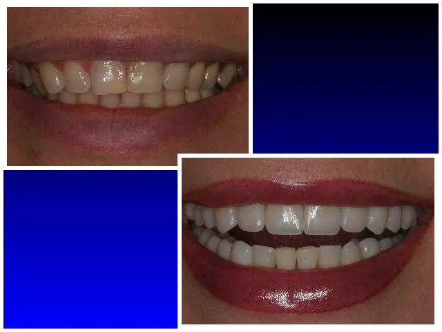 Before & After Porcelain Veneers