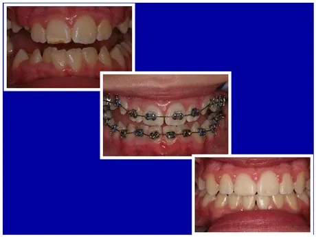 Before and After Braces, patient photos, photo of teeth with braces