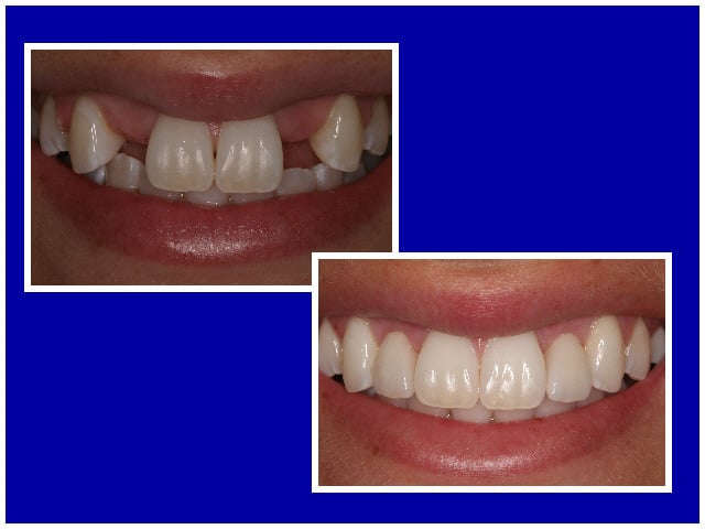 Dental Implants Wellington