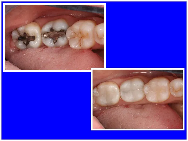 Before & After Dental Fillings