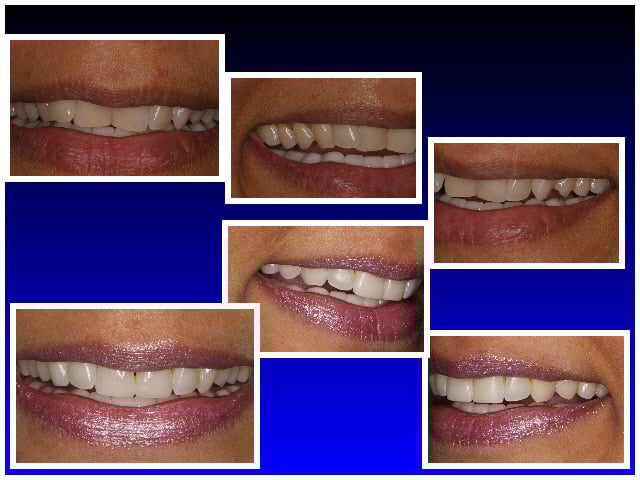 Before & After Invisalign