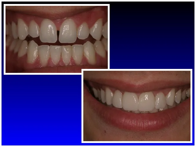 Before & After Veneers