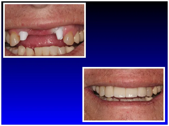 Before & After Dental Implants with Bridge