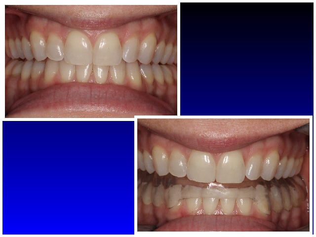 Before & After with mouth guard for clenching & grinding teeth 