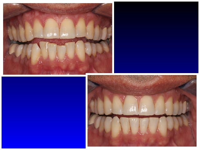 Before & After Invisalign