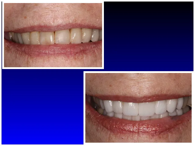 Before CEREC Porcelain Veneers 