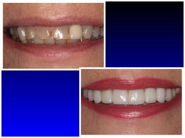 Before & After Porcelain Veneers