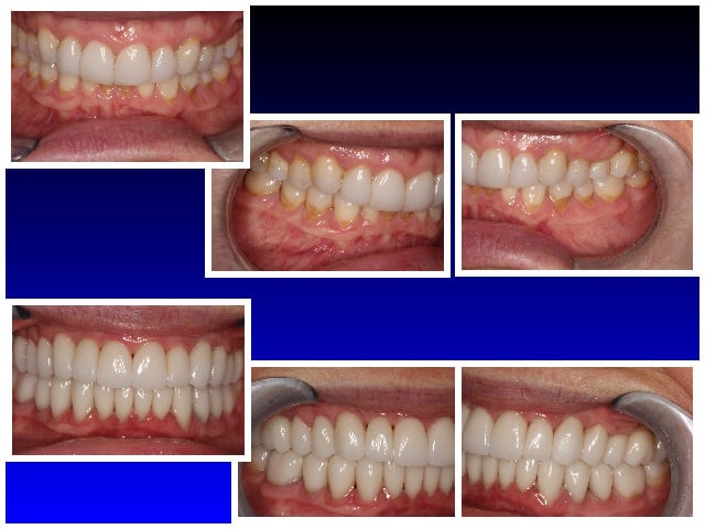 Before & After Full Reconstruction: