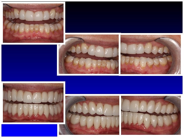 Before & After Full Mouth Reconstruction: