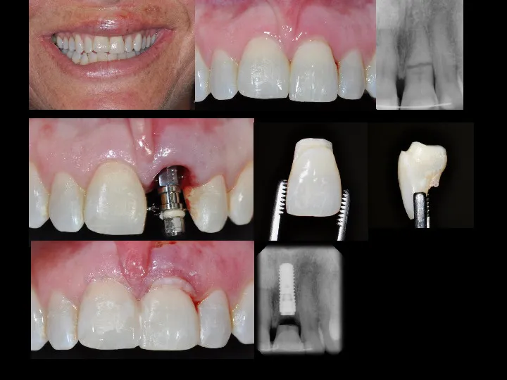 Wellington Center for Laser Dentistry, replace lost tooth