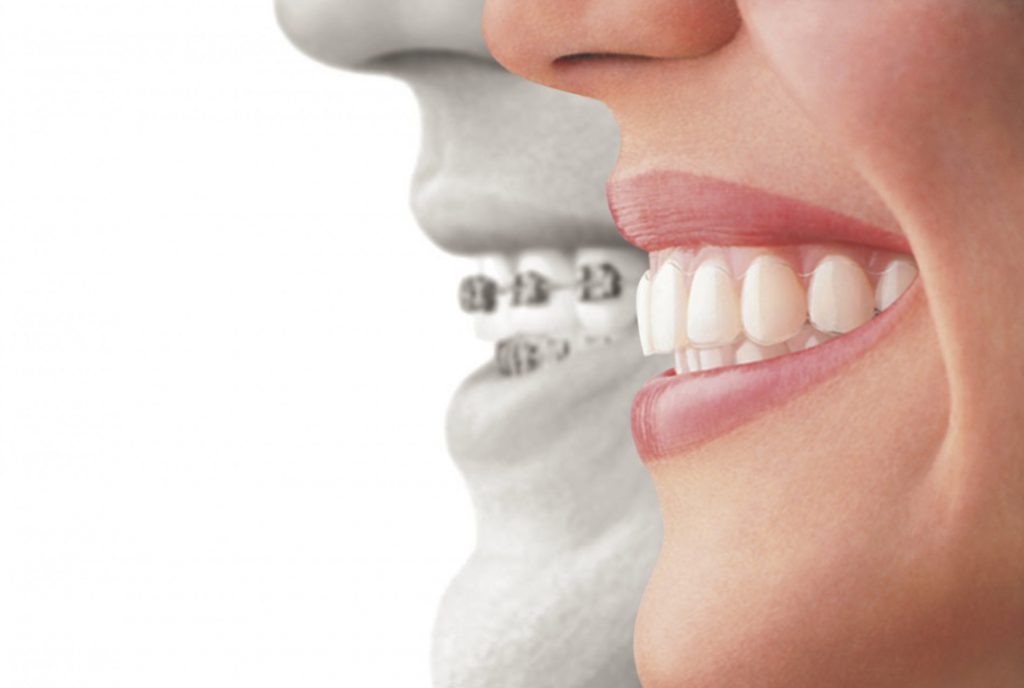 Aligner Profiles