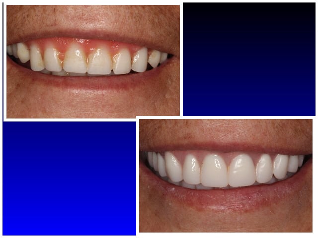 Before & after dentures