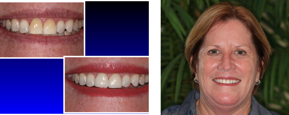 Before & After Before CEREC Porcelain Veneers 