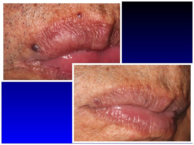 Before & After Removal of Hemongioma with NdYag Laser