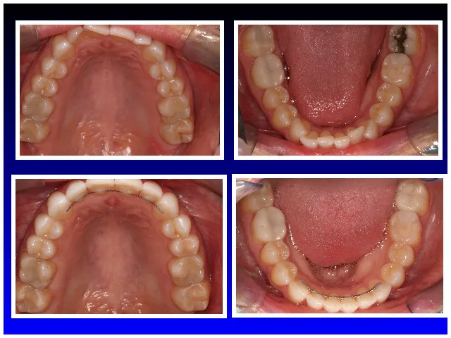 Before & After neuromuscular braces