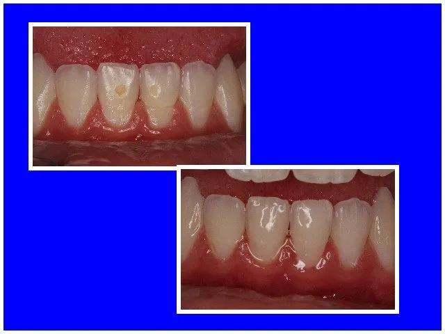Tooth-colored fillings bonded to the teeth to repair abfractions at the gum line