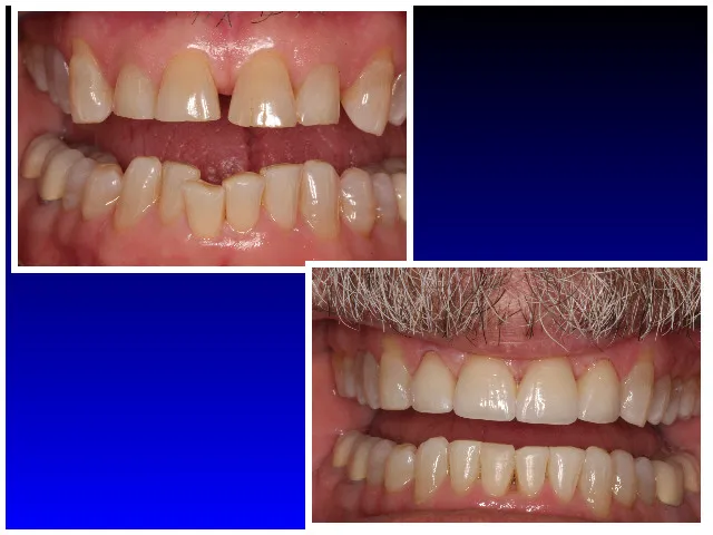 Before & After Invisalign
