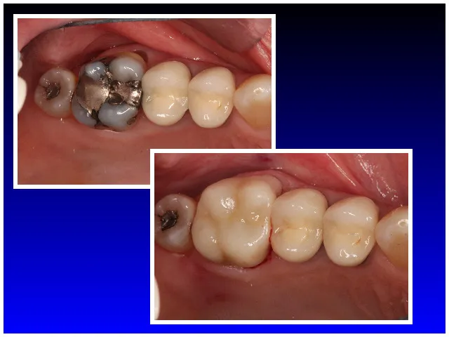 Replacing metal restorations with porcelain crowns