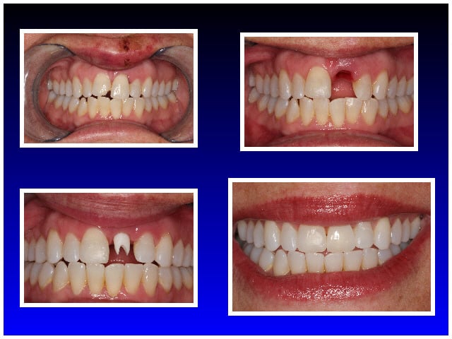 Wellington Center for Laser Dentistry, dental implants