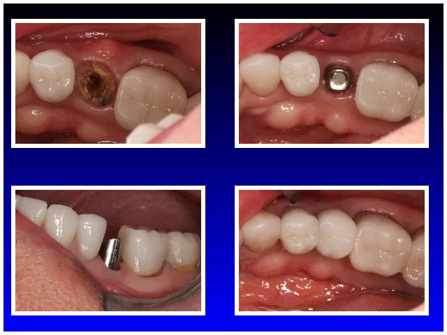 Fractured Tooth Restored with Implant