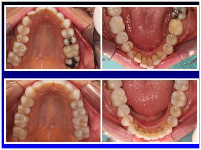 Before & After Invisalign