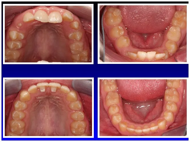 Before & After neuromuscular braces