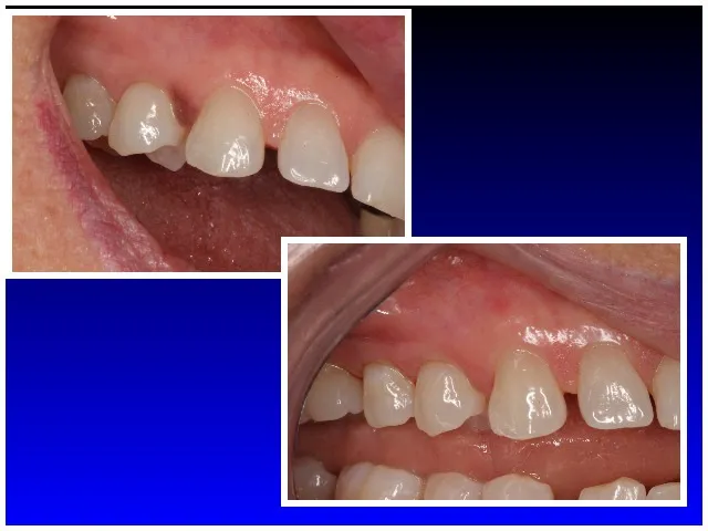 Before & After Removal of Pigmented Lesion