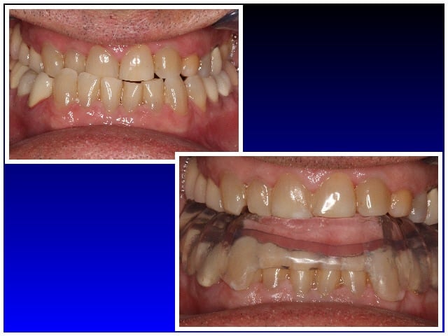 Before and after Neuromuscular treatment 