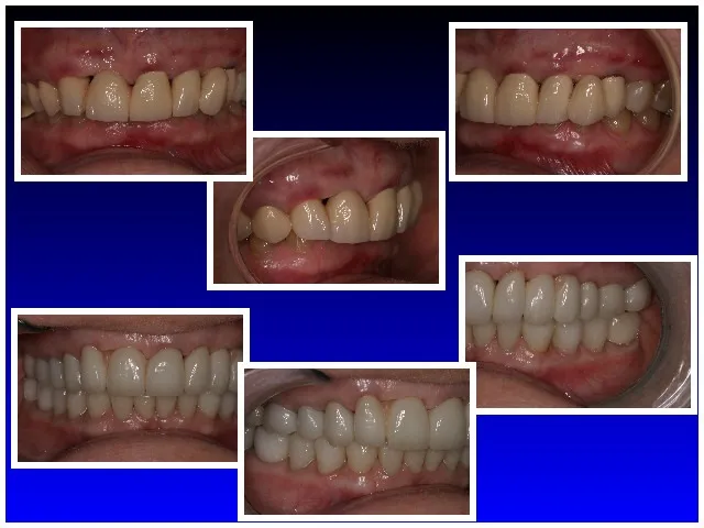 Before & After Full Mouth Reconstruction: