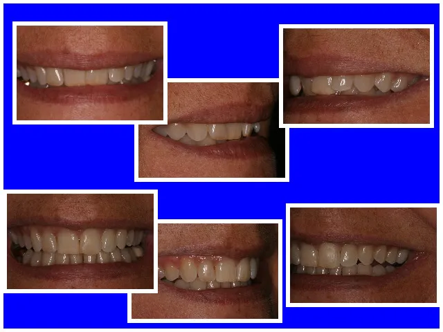 Before & After Invisalign