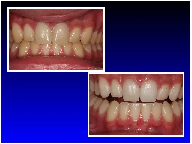 Before & After Laser Whitening