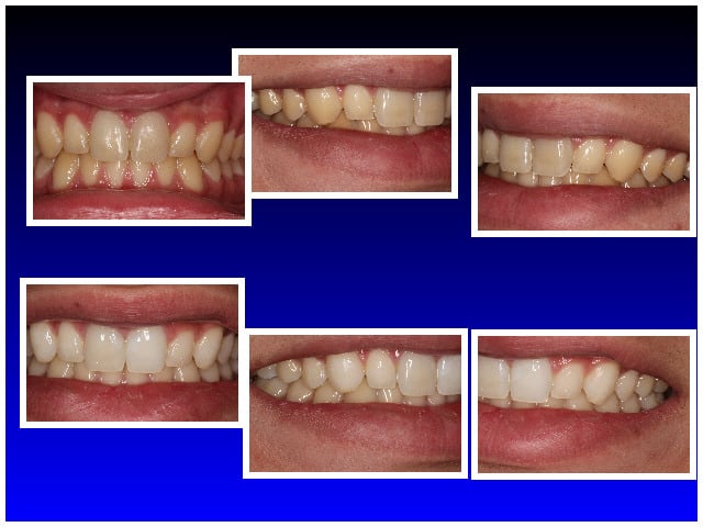 Before and After Teeth Whitening