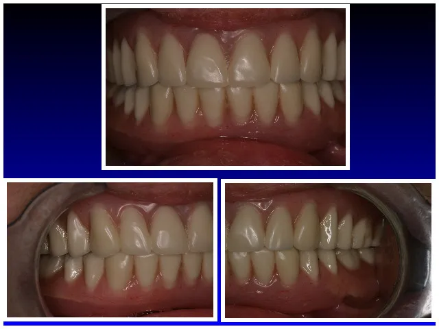 BEFORE & AFTER: IMPLANT SUPPORTED LOCATOR OVER DENTURE (TOP & BOTTOM)