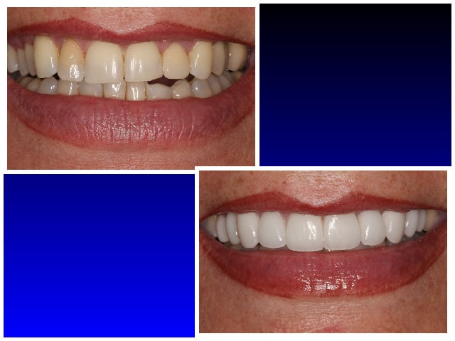 Before & After Invisalign with Veneers