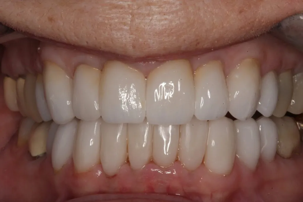 After CEREC Porcelain Veneers