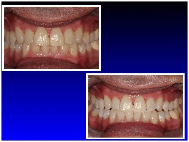 Before and After Teeth Whitening