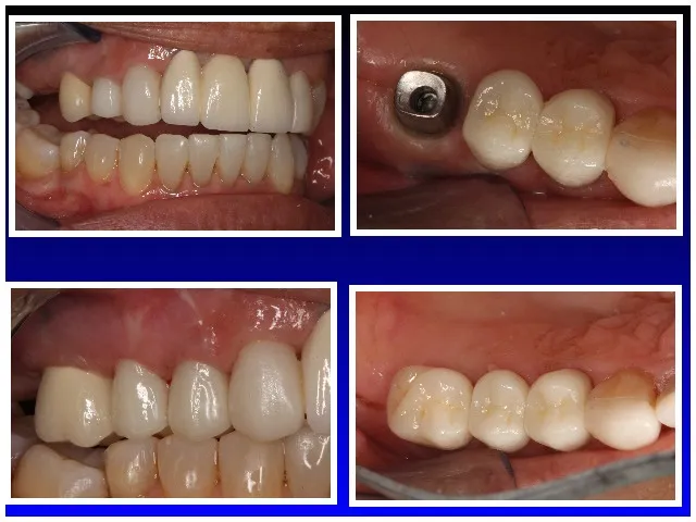 Dental Implants Wellington