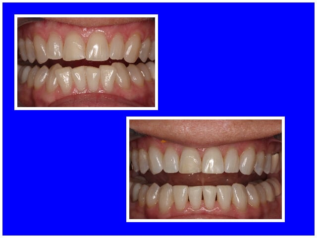 Before & After Invisalign