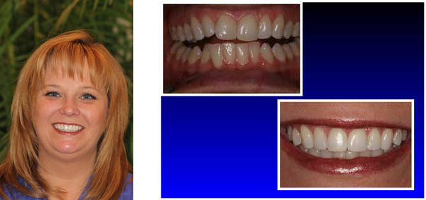 before and after braces by Wellington Laser Dentistry