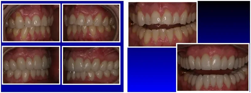 William-Genz before and after reconstruction