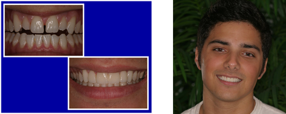 Before & After Porcelain Veneers