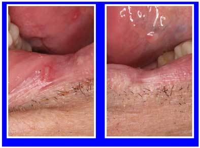 Apthous Ulcer Laser Treatment Before and After