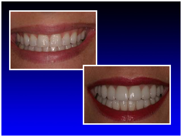 Before & After images of full mouth Reconstruction