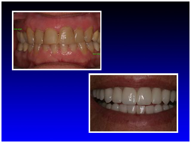 Before & After A Full Reconstruction
