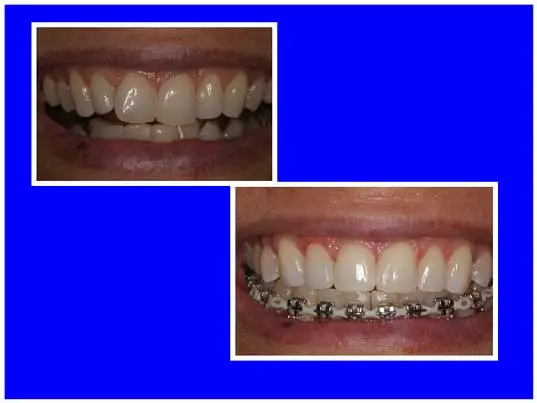 Before and After Teeth Whitening