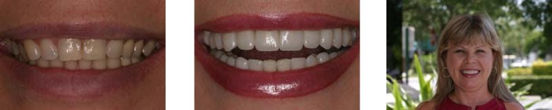 Before and after full mouth reconstruction