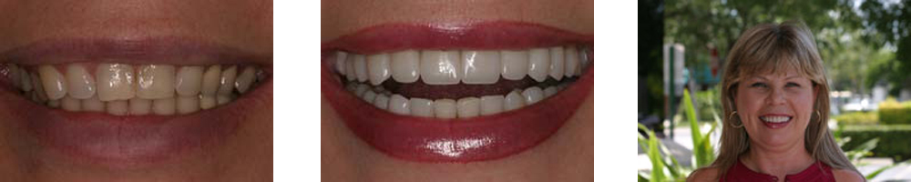 Before and after full mouth reconstruction