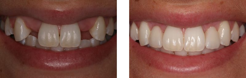 Before and after implants image